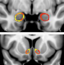 In these cross-sectional MR images, taken at different points within the brain, the red and yellow coloring indicates that grey matter density in the left nucleus accumbens – a region involved with reward and motivated behavior – is significantly greater in recreational marijuana users than in non-users. (Reprinted with permission: GILMAN, et al. The Journal of Neuroscience 2014.)